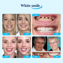 Alternative view of WHITESMILE™ – Ρυθμιζόμενη Καλλυντική Οδοντική Όψη